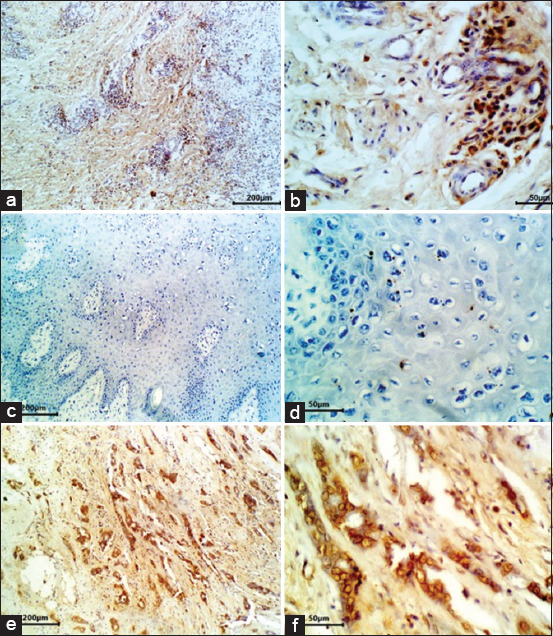 Correlation between p53 and Mdm2 expression with histopathological parameters in cattle squamous cell carcinomas.